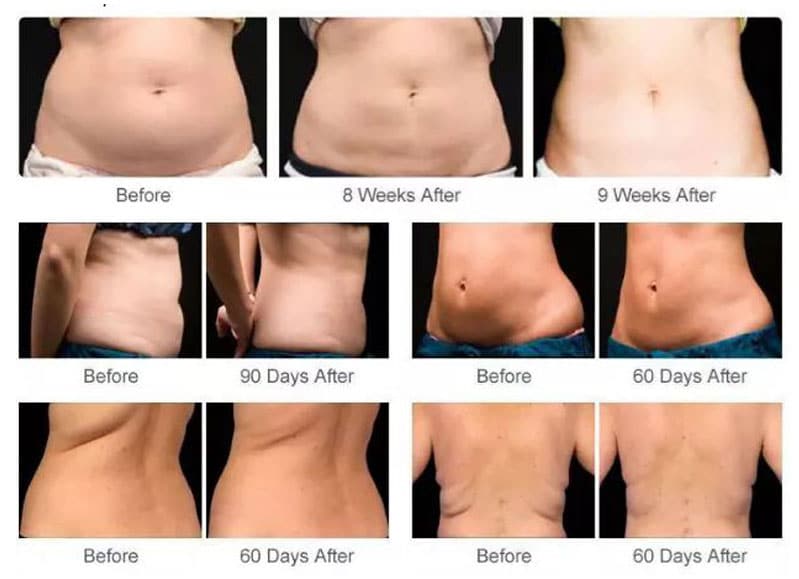 Body Shaping - Body Contouring and Slimming Treatments